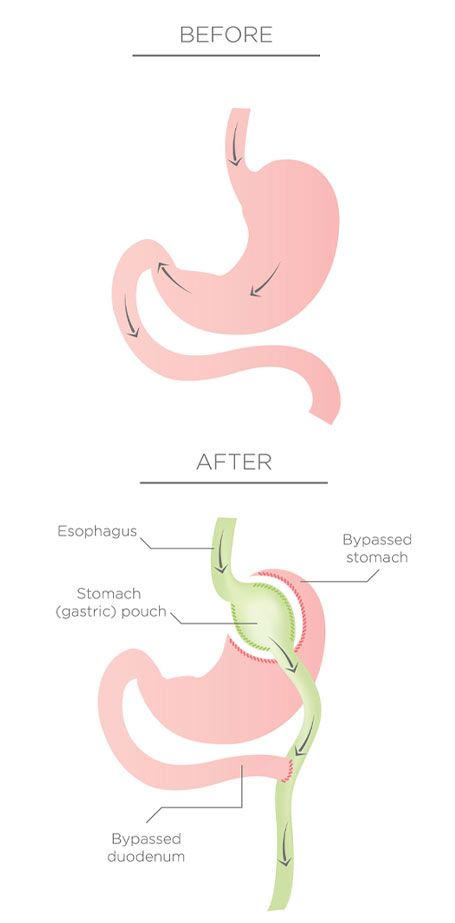 Before and after gastric bypass surgery